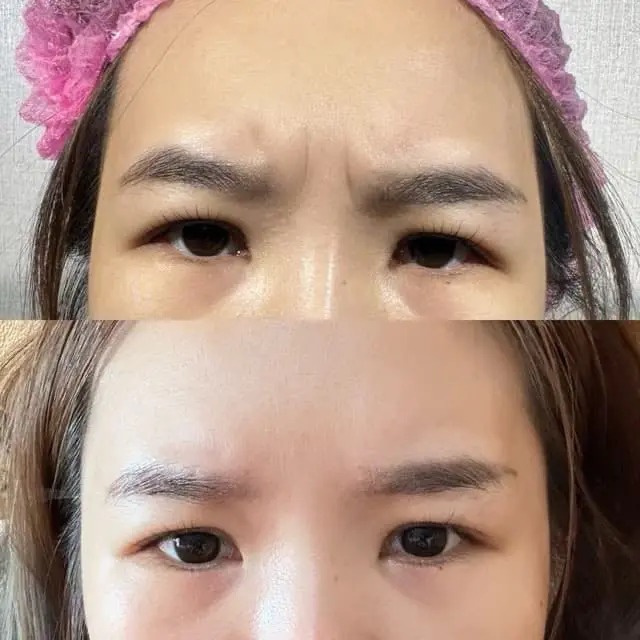 真的很推推如果敢嘗試入針是保養可以從肉毒桿菌開始 效果一定不會讓你們失望的
